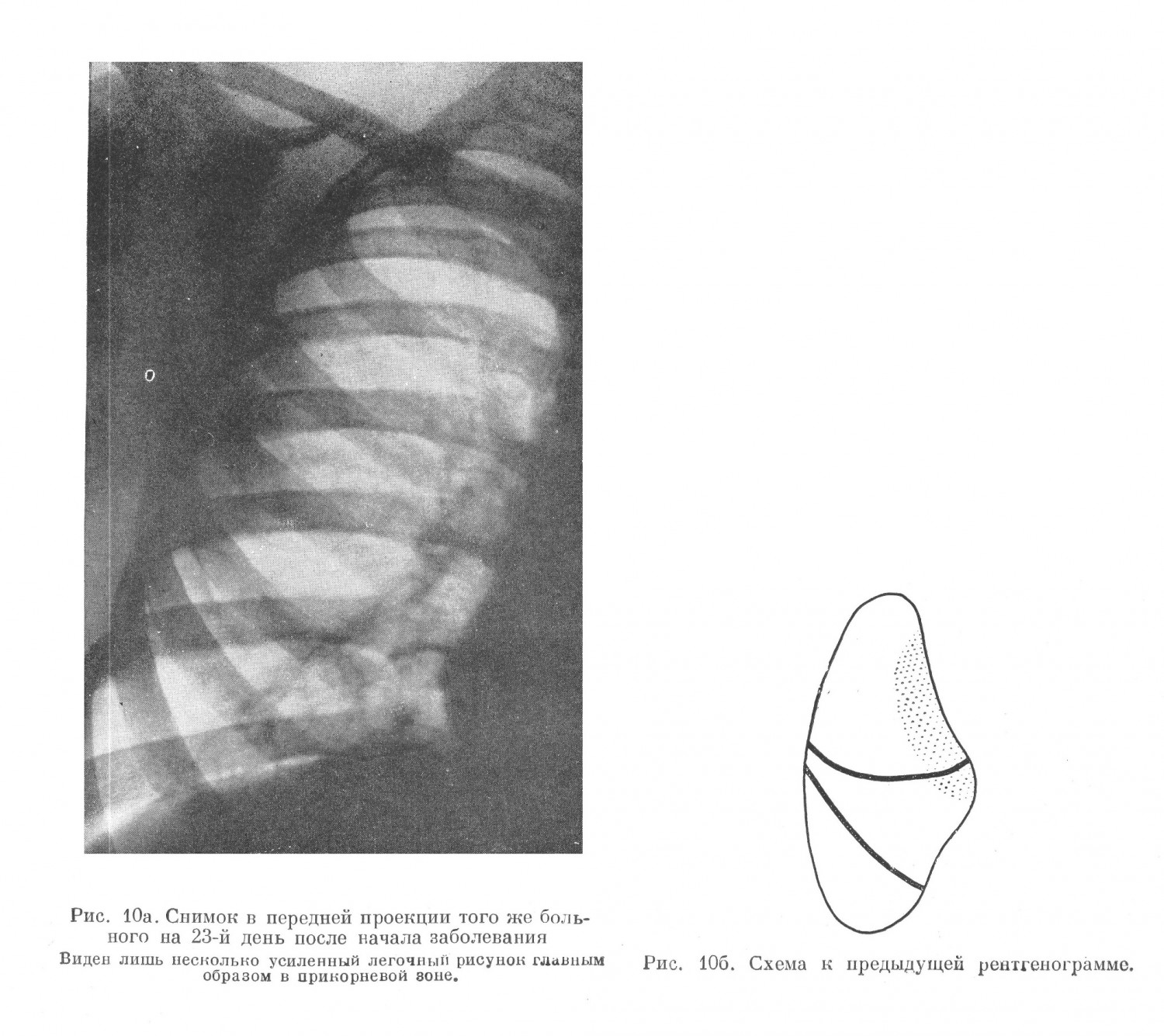 Рентгенодиагностика крупозной пневмонии