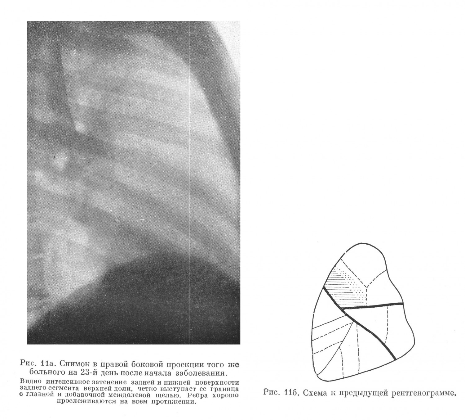 Рентгенодиагностика крупозной пневмонии
