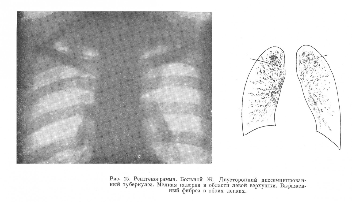 При рентгеноскопии обнаружен двусторонний диссеминированный туберкулезный процесс