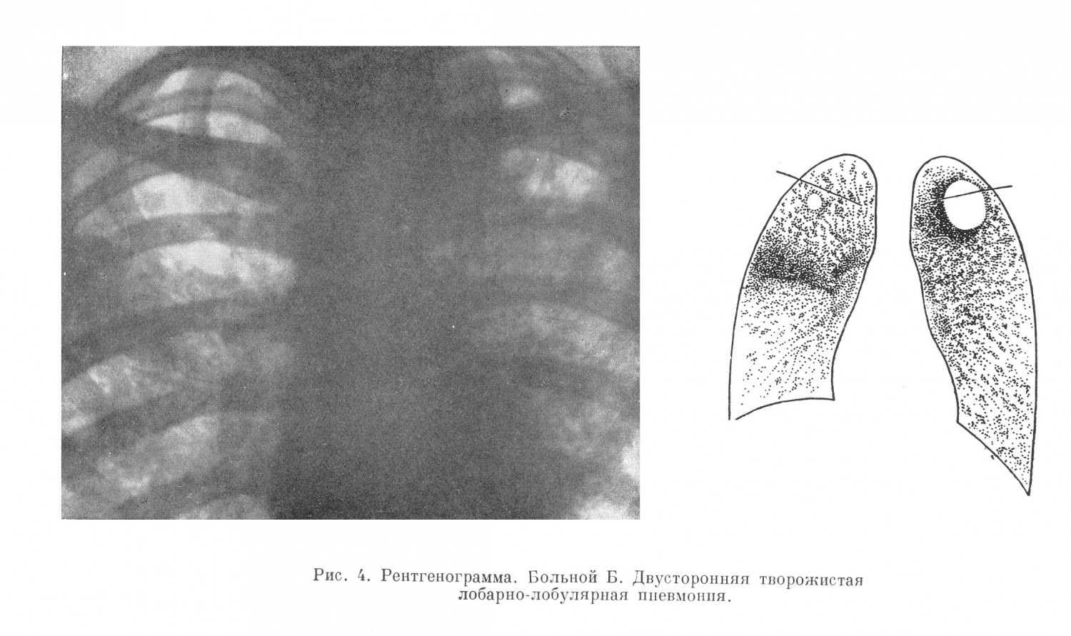 при рентгеноскопии была диагносцирована двусторонняя лобарно-лобулярная творожистая пневмония