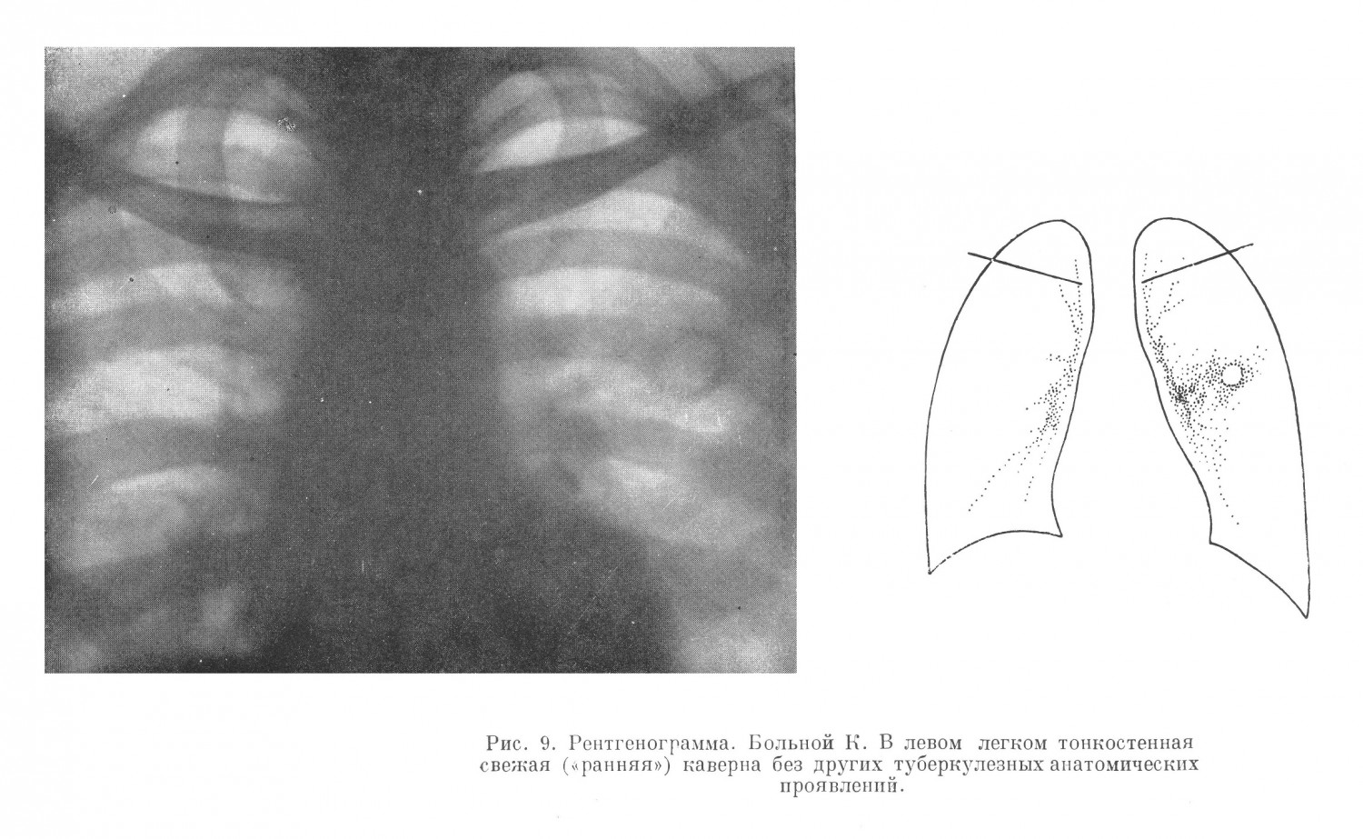 рентгенологическом обследовании в левом легком был обнаружен ранний инфильтрат