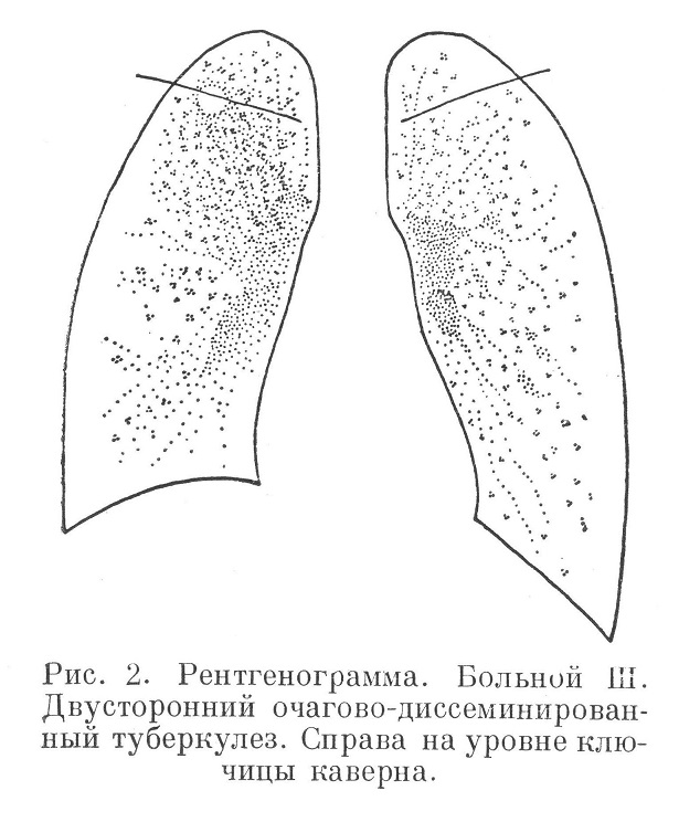 Двусторонний очагово-диссеминированный туберкулез. 