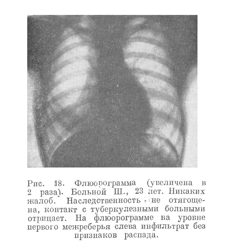 формы первичного туберкулеза в фазе инфильтрации без распада