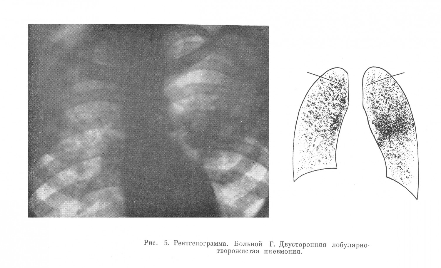 При рентгенологическом исследовании обнаружена типичная картина далеко зашедшей двусторонней лобулярно-творожистой пневмонии со множественными свежими кавернами