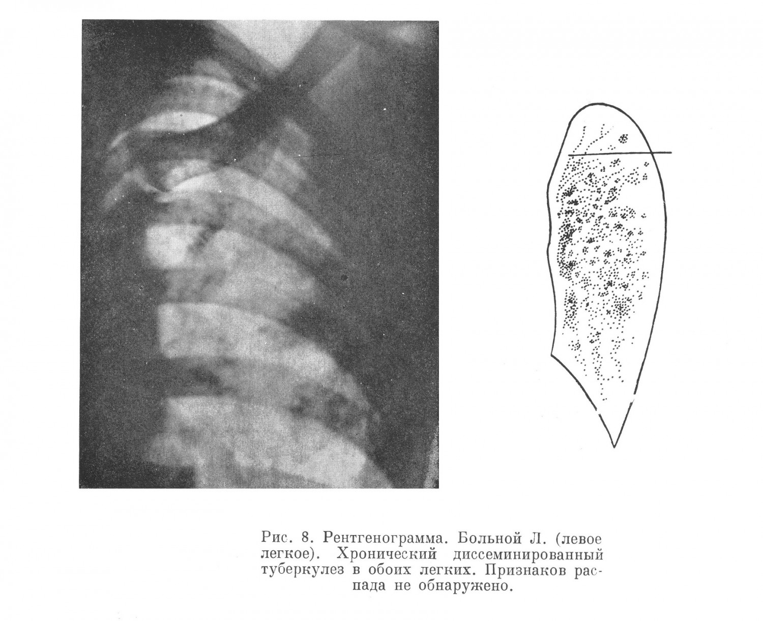 При рентгенологическом обследовании выявлен двусторонний диссеминированный туберкулез