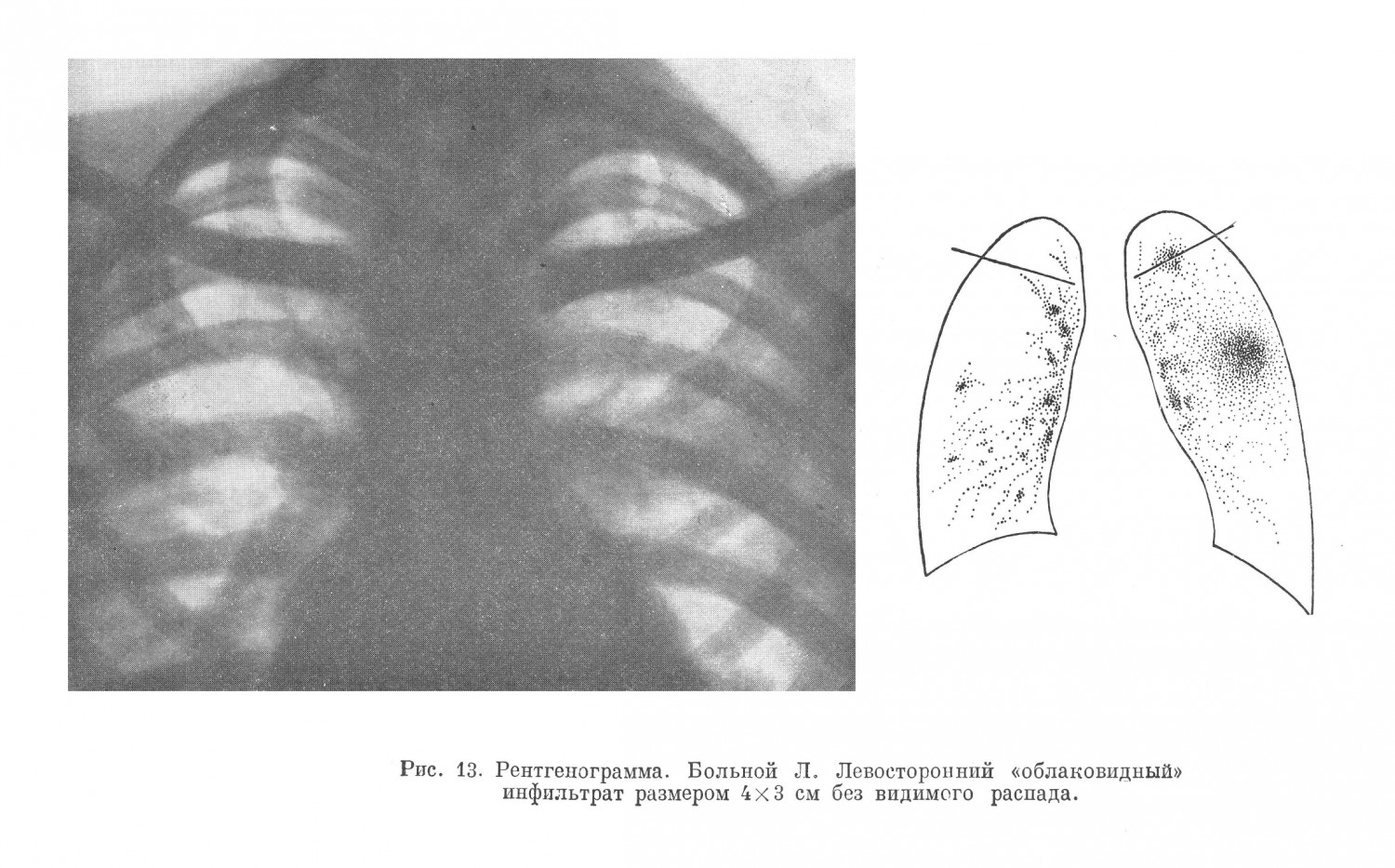 рентгеноскопии обнаружен левосторонний (во втором межреберье) облаковидный инфильтрат размером