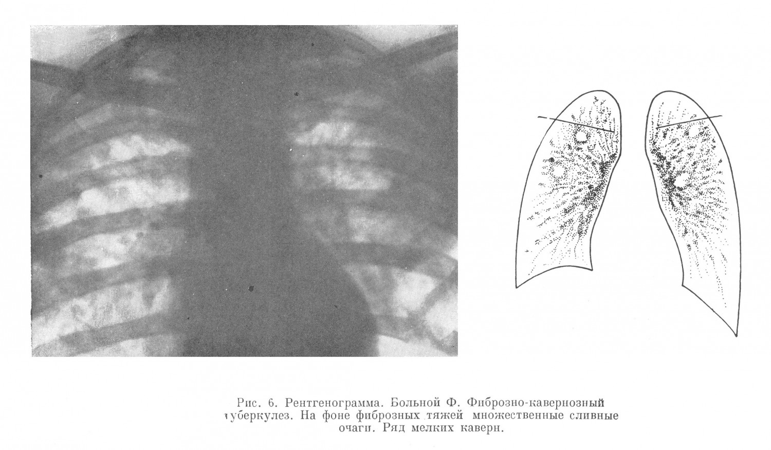 При рентгеноскопии в обоих легких обнаружены грубые фиброзно-тяжевидные изменения с множеством крупных сливных очагов