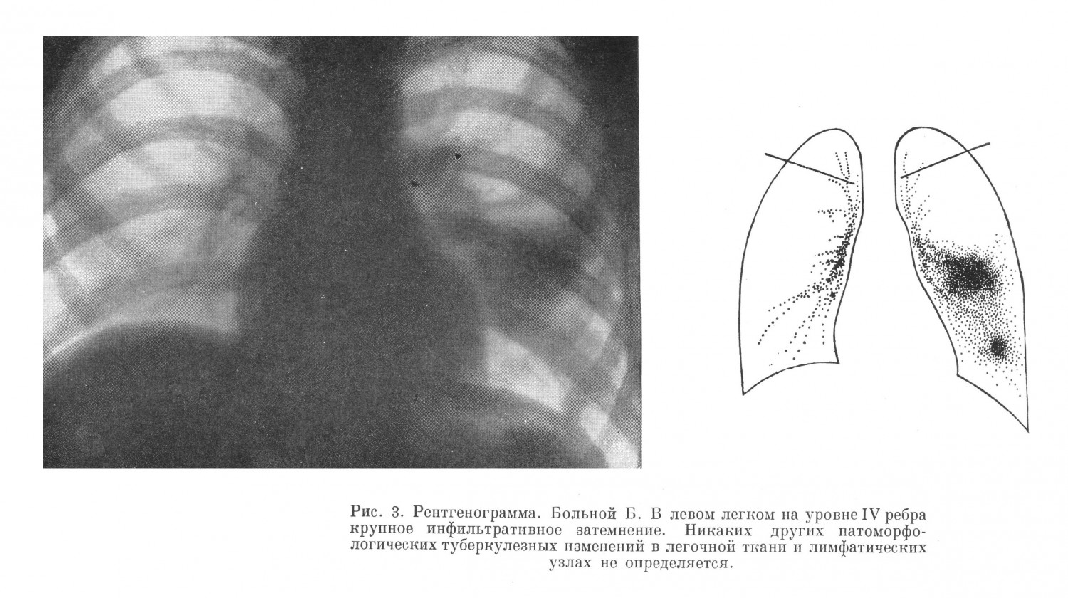 Рентгенограмма туберкулез легких